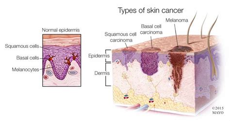 Basal And Squamous Cell Skin Cancer Symptoms : Early Signs of Skin Cancer Pictures â€“ 15 Photos ...