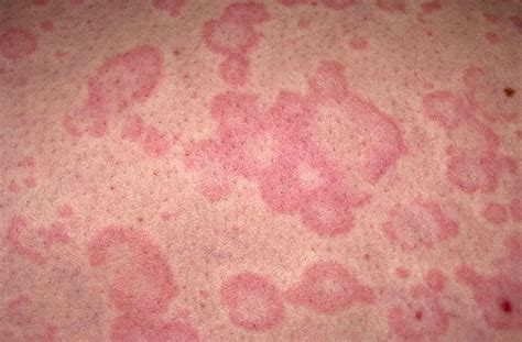 Hives Urticaria