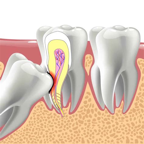 Why Do People Remove Their Wisdom Teeth