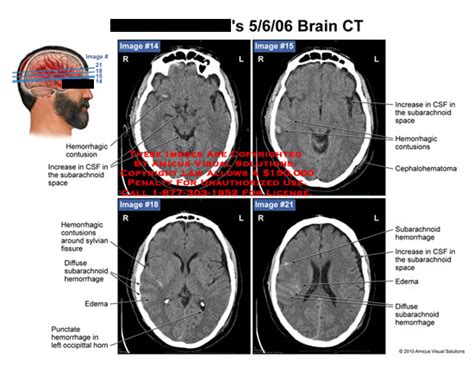 Amicus Illustration Of Amicus Radiology Brain Ct Hemorrhagic Contusion