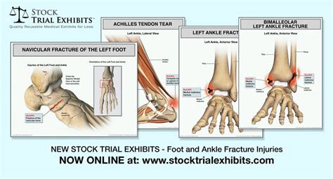 Medial Malleolus Ankle Fracture : The Radiology Assistant Ankle ...