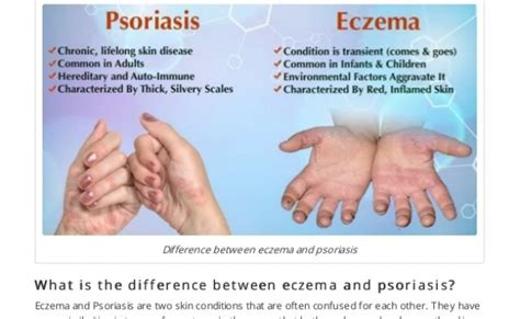 Psoriasis Vs Eczema Whats The Difference Otosection