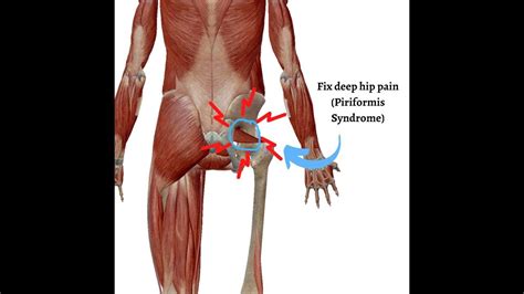 A Real Pain In The Butt Piriformis Syndrome Surge Physiotherapy A Hot