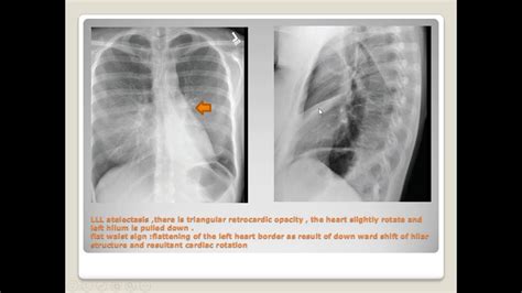 Secondary Pulmonary Lobules Pathology Youtube