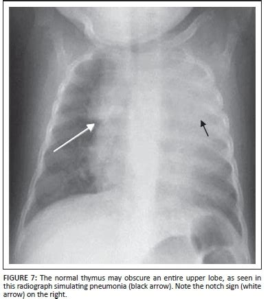 Pitfalls And Mimics The Many Facets Of Normal Paediatric Thymus