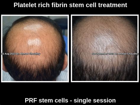 Most Effective Hair Regrowth Treatment Lahore Pakistan Get Free Advice