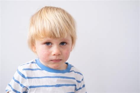 Premium Photo Portrait Of Little Boy With Allergic Rash Or Eczema On