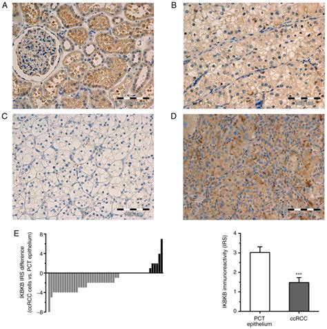 IKBKB Expression In Clear Cell Renal Cell Carcinoma Is Associated With