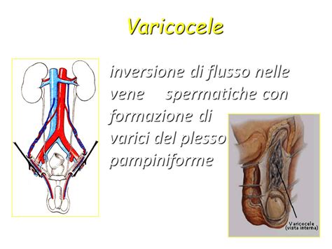 Varicocele Paolo Dott Pompa Urologo