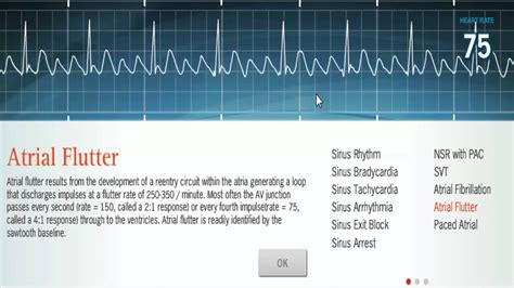 Atrial flutter vs afib ecg - sterbery