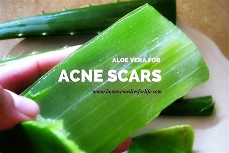 9 Easy Ways To Use Aloe Vera For Acne Scars Wellness Guide