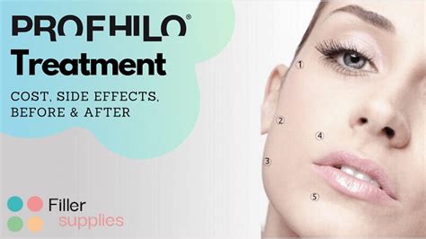 Profhilo: Cost, Side Effects, Results | FillerSupplies