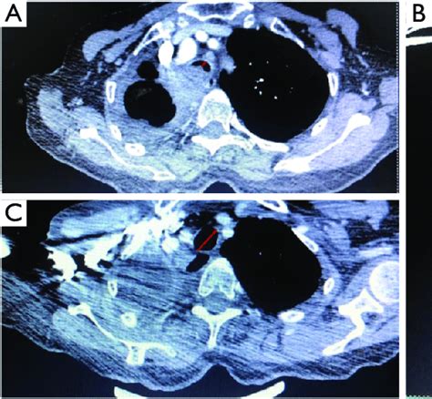 Measurement Of The Airway Stenosis Indexes Lumen Diameters Were