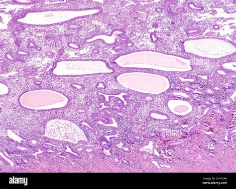 Nonatypical Endometrial Hyperplasia Light Micrograph Stock Photo Alamy