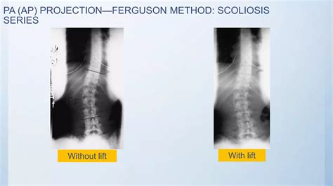 Radiographic Views Of Lumbar Spine Ppt