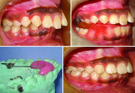 Versatile Twin Block Design For Noncompliance Class Ii Correction Apos Trends In Orthodontics