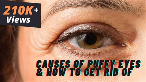 What Causes Puffy Eyes How To Get Rid Of It Cosmetic Expert Dr