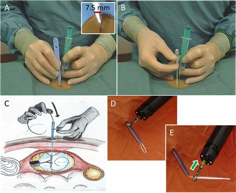 Scalpel Incision And Thread Trocar Incision A Converging Puncture In