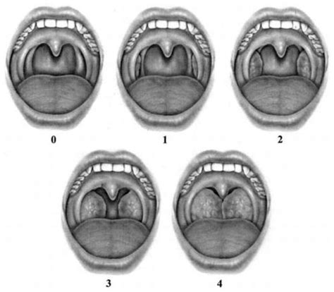 Surgical Treatment Options For Obstructive Sleep Apnea Intechopen