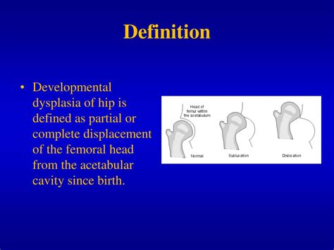 Ppt Develompmental Dysplasia Of The Hip Ddh Powerpoint Presentation Id3701351