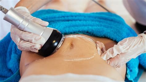 Fat Cavitation And Fat Loss Your Complete Guide