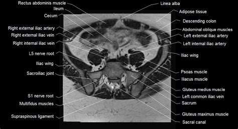 Female Pelvis Anatomy Free Axial Cross Sectional Anatomy Of Female Pelvis