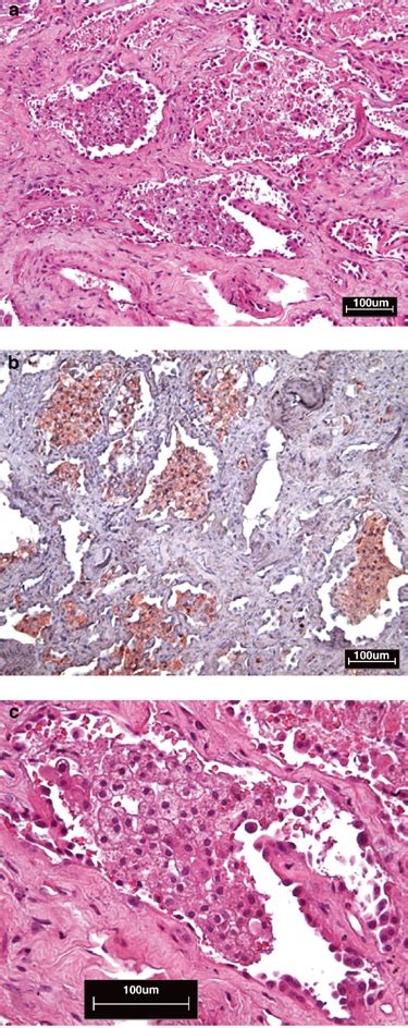 Interstitial Fibrosis With Marked Hyperplasia Of Type II Pneumocytes