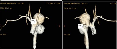 Diagnostiquer un anévrisme de l aorte thoracique Fmedic