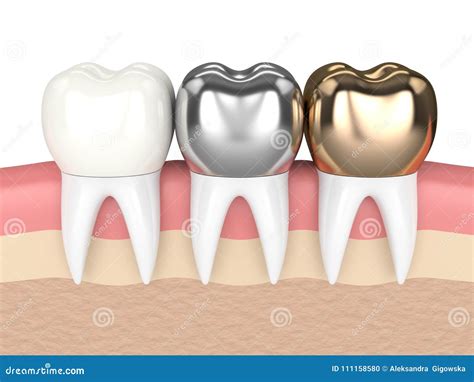 3d Rendem Dos Dentes Tipos Diferentes De Coroa Dental Ilustração