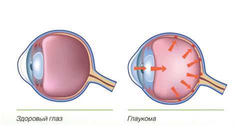 Глаукома
