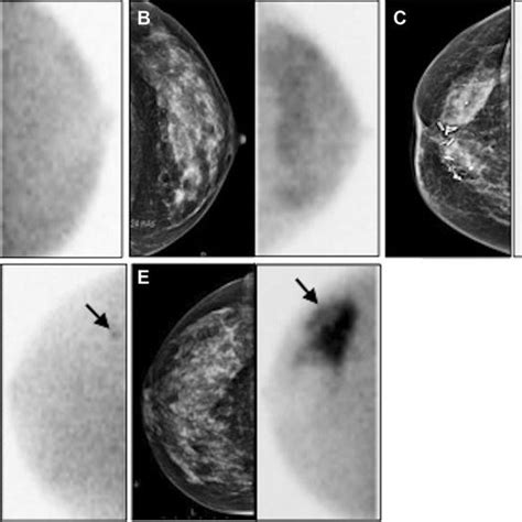 Pdf Methodological Aspects Of Mtc Sestamibi Guided Biopsy In Breast