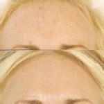 Fraxel Laser Resurfacing Washington Dc Center For Laser Surgery