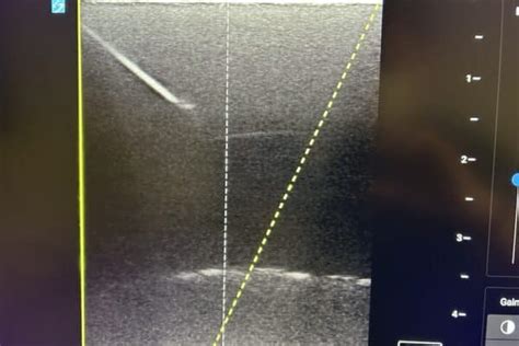 Ultrasound Guided Pericardiocentesis Benefits And Techniques