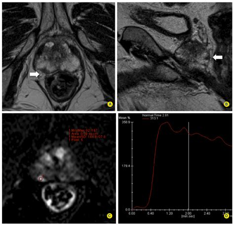 Figure 2 From The Role Of Multiparametric Magnetic Resonance Imaging