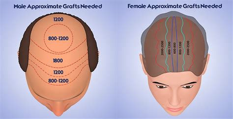 3000 Grafts Hair Transplant Cost In Lahore Pakistan Specialist Clinic