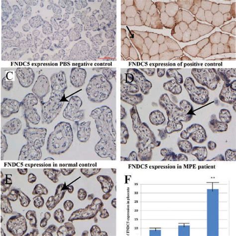 Expressions Of Irisin Precursor Fndc In Placental Tissue By