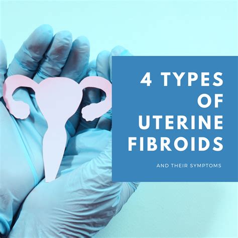 4 Types Of Uterine Fibroids And Their Symptoms New York City 1 Fibroid Center