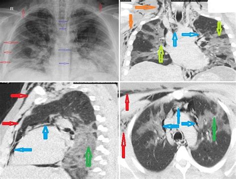 Chest X Ray And Ct Show Spontaneous Pneumomediastinum Blue Arrows