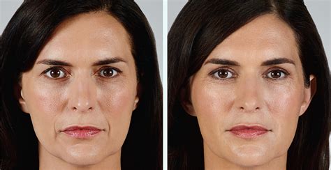 Juvederm Ultra Xc Coeur D Alene Plastic Surgery