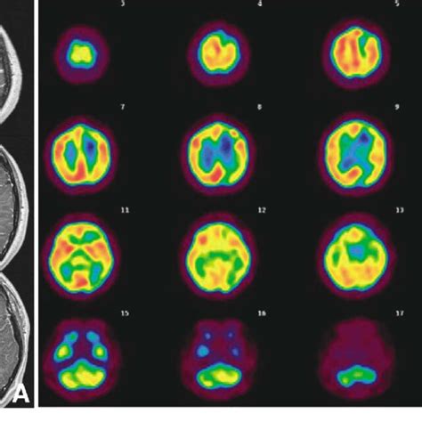 Case 1 A Preoperative Axial T 1 Weighted Magnetic Resonance Images Download Scientific