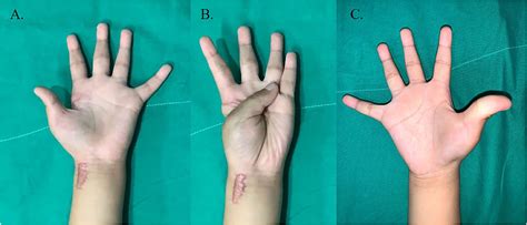 Frontiers Characteristics Of Congenital Clasped Thumb A Case Report