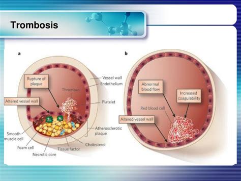 PPT - TROMBOSIS PowerPoint Presentation, free download - ID:7081885