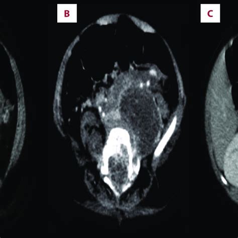 A Contrast Enhanced Axial Computed Tomography Shows A Heterogeneously