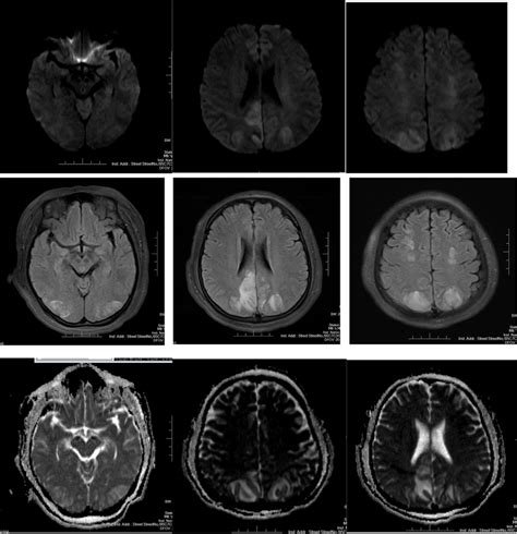 Brain Mri In A Patient With Eclampsia With Hypothyroidism Complicated