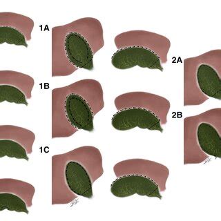 Lunevicius Classification Subtotal Cholecystectomy A Circular