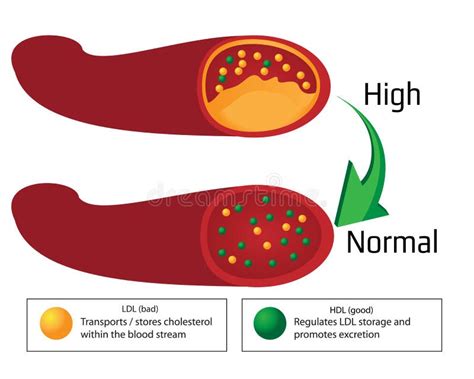 Turning High Level Of Atherosclerotic Plaque In Blood Vessel Into