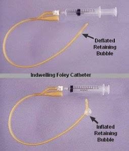 foley catheter indications Archives - Webdicine