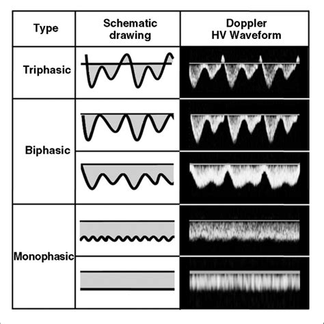 Triphasic Arterial Waveforms