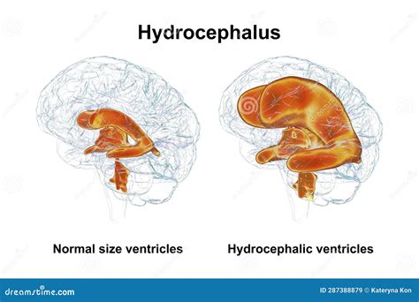 Enlarged Ventricles of the Child Brain and Normal Ventricular System, 3D Illustration Stock ...