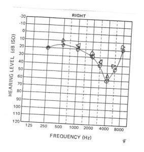 Pure Tone Audiogram And Interpretation Epomedicine